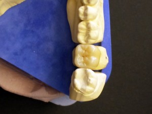 Metallfreier keramischer Zahnersatz