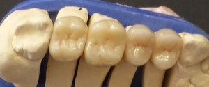 Metallfreier keramischer Zahnersatz