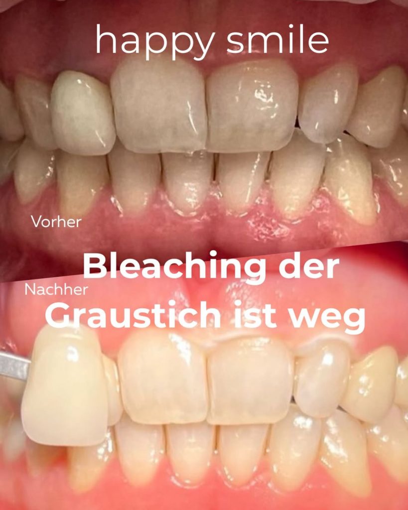 Sanftes Bleaching in unseren Zahnarztpraxen
