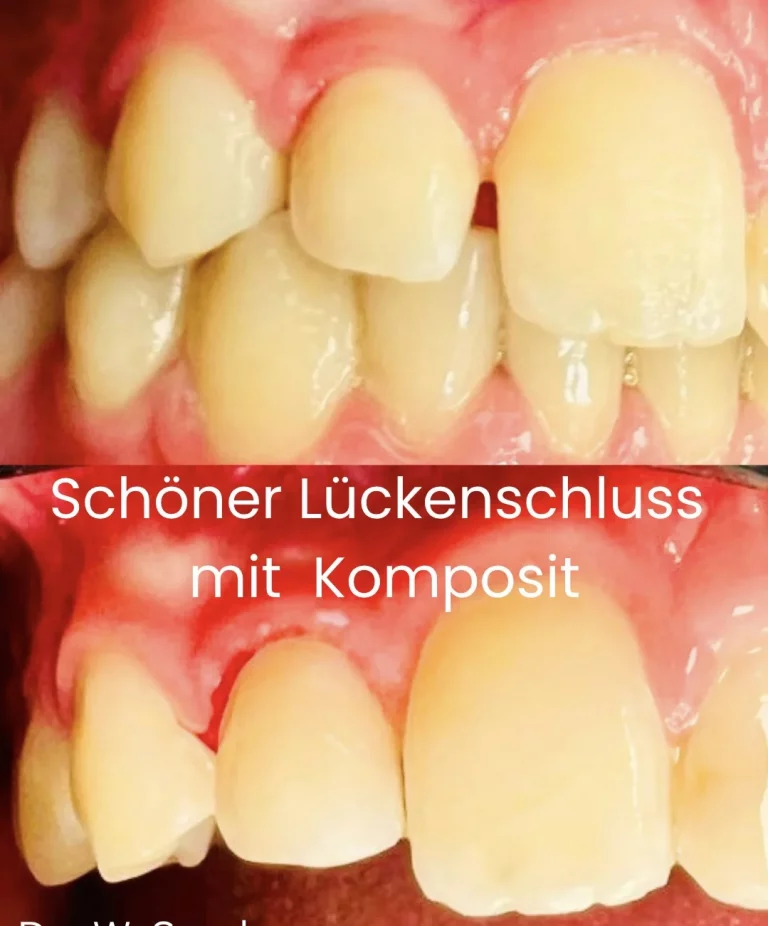 Ästhetische Frontzahnbehandlung mit Vorher-Nachher-Ansicht