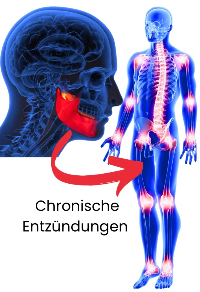 Chronische Entzündungen durch Zähne verursacht