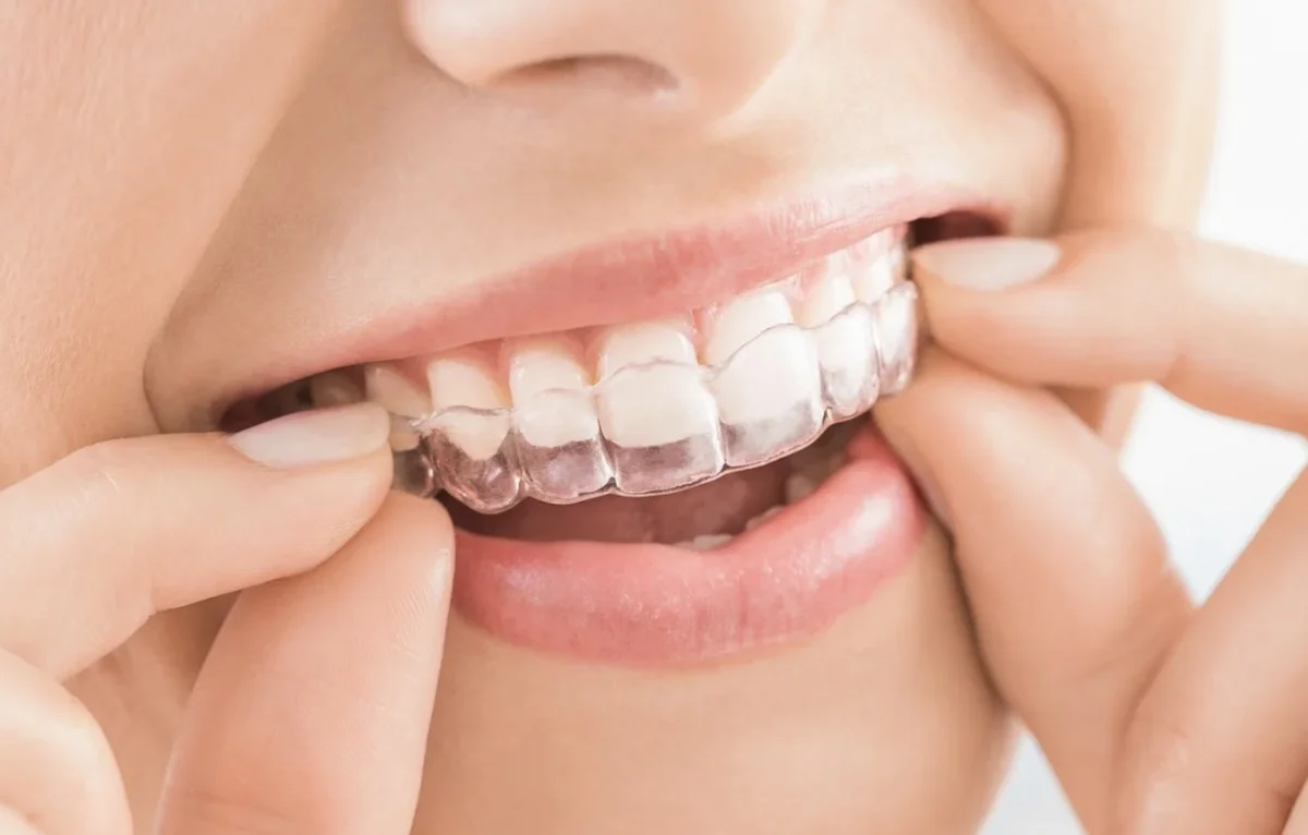 Invisalign Aligner