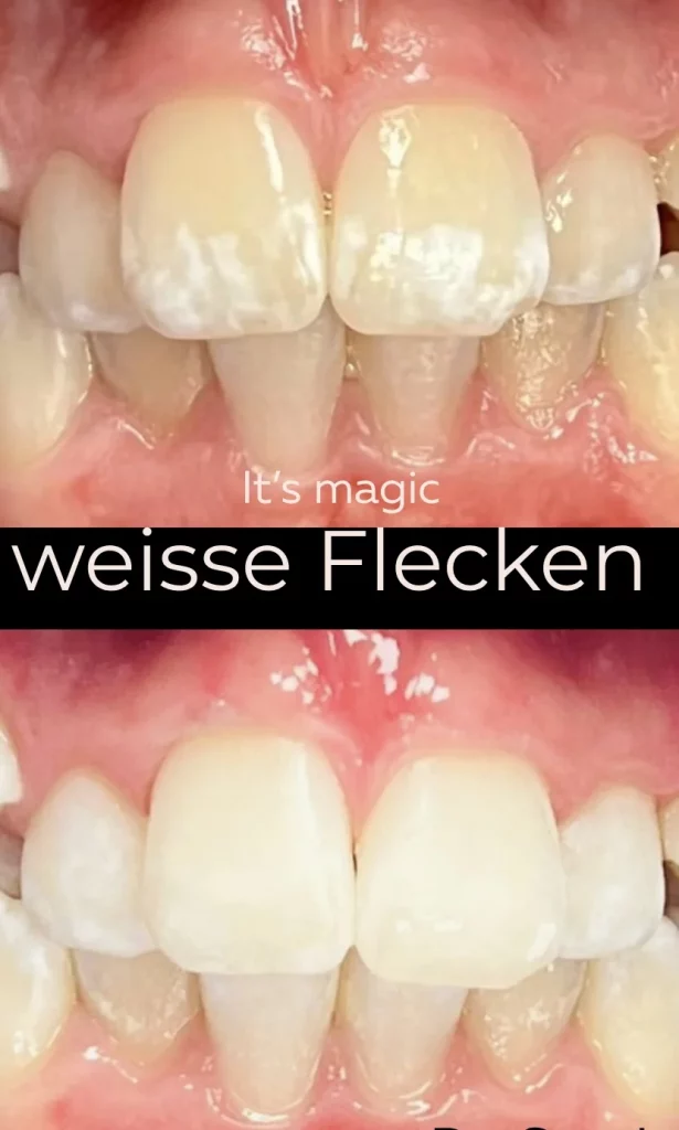 Weiße Zähne dank Icon-Behandlung