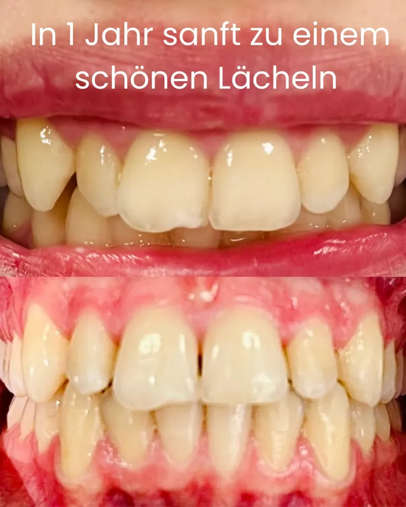 Vorher Nachher Foto Zahnkorrektur