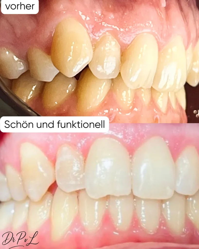 Vorher Nachher Foto Zahnkorrektur