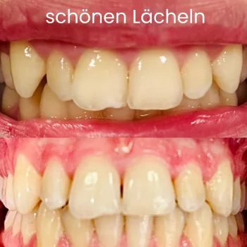 Ästhetische Frontzahnbehandlung mit Vorher-Nachher-Ansicht