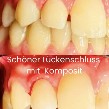 Ästhetische Frontzahnbehandlung mit Vorher-Nachher-Ansicht