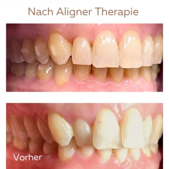 Aligner therapie vorher nach zahnarzt doctores von landenberg