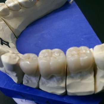 Metallfreier keramischer Zahnersatz