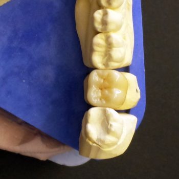 Metallfreier keramischer Zahnersatz