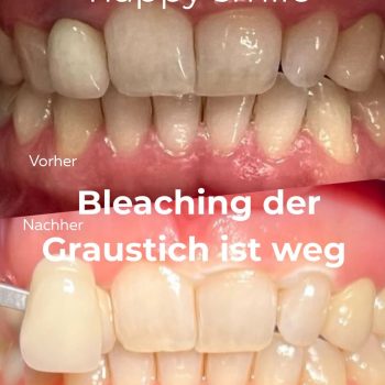 Sanftes Bleaching in unseren Zahnarztpraxen